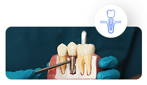 Dental-Implants https://globaltest.web.boundlesstechnologies.net/wp-content/uploads/2025/09/Dental-Implants.png